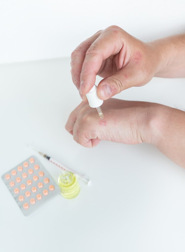 A man spreads healing gel on his hands. Causes of itchy skin can be dermatitis (eczema)