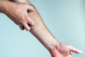 Unrecognizable man suffering from psoriasis scratching thick clusters, flaky rash on skin of arm wit